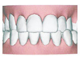 Malocclusione trattabile con Invisalign®, tipologia 3